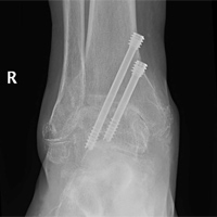 Ankle Arthritis - Arthrodesis