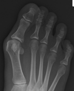 Hallux Valgus