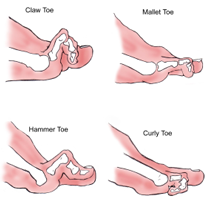 Hammer Toe