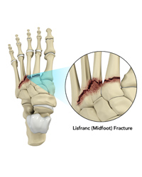 Lisfranc (Midfoot) Injury