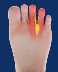 Mortons Neuroma Resection
