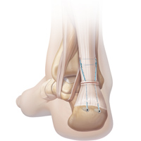 Achilles Tendon Rupture – Percutaneous Repair