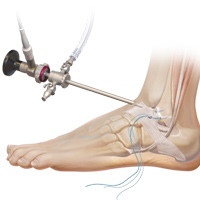 Anterior Ankle Artrhoscopy