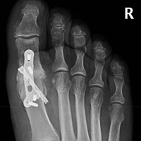 Hallux Rigidus - Arthrodesis