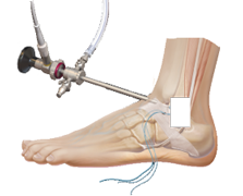 Ligament reconstruction