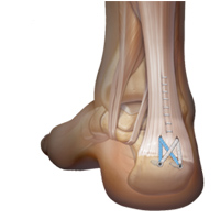 ACHILLES INSERTIONAL DEBRIDEMENT (SPUR REMOVAL) AND REPAIR