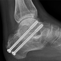 Subtalar Joint Arthritis - Arthrodesis