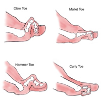 Toe Straightening