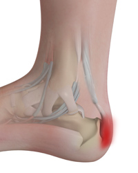 Achilles Insertional Debridement & Repair