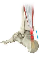 Achilles Tendon Repair (Minimally Invasive)