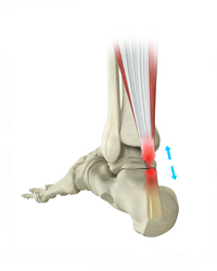 Achilles Tendon Rupture