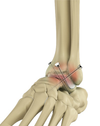 Ankle Arthrodesis/Fusion