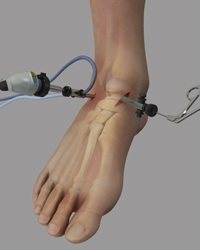 Ankle Arthroscopy