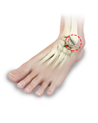 Rheumatoid Arthritis of the Foot & Ankle
