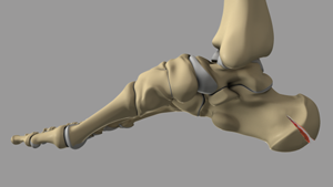 Calcaneal Fractures