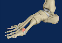Cheilectomy