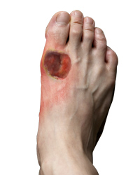 Diabetic (Charcot) Foot