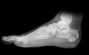 Calcaneal Fractures