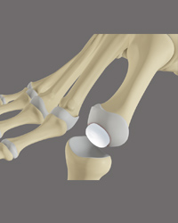 Hallux Rigidus - CARTIVA