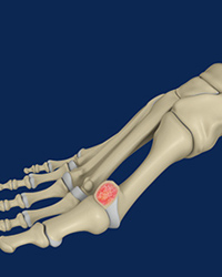 Hallux Rigidus – Cheilectomy