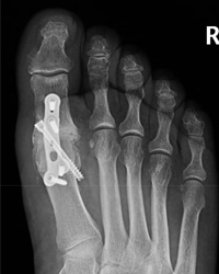 Hallux Rigidus - Arthrodesis