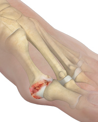 Hallux Rigidus – Osteotomy