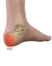 Heel Pain