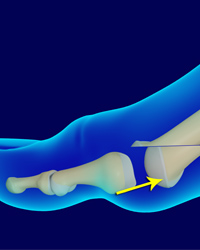 Metatarsal Shortening