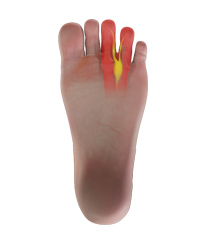 Morton's Neuroma