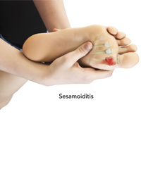 Sesamoiditis