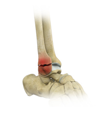 Stress Fractures of the Foot and Ankle