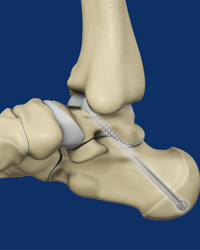 Subtalar Arthrodesis/Fusion