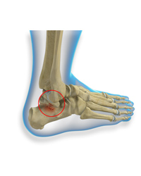 Talus Fractures