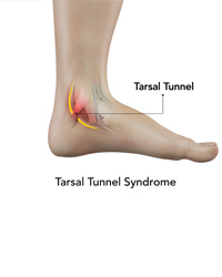 Tarsal Tunnel Syndrome