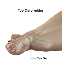 Toe Deformities