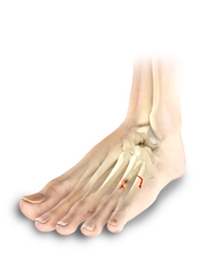 Toe and Forefoot Fractures