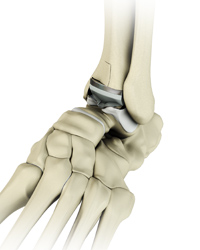 Total Ankle Replacement